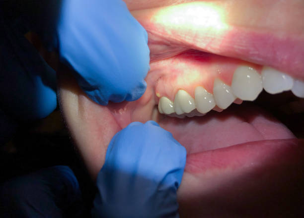 Best Broken Tooth Emergency  in Blackhawk, CA